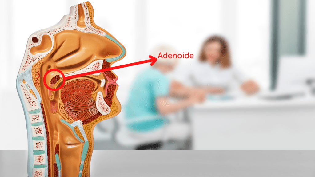 Adenoide o que é quando precisa de cirurgia e como cuidar