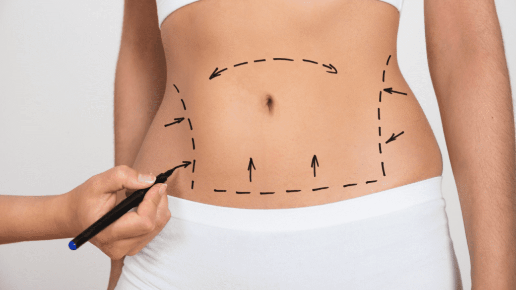 semana após cirurgia plástica