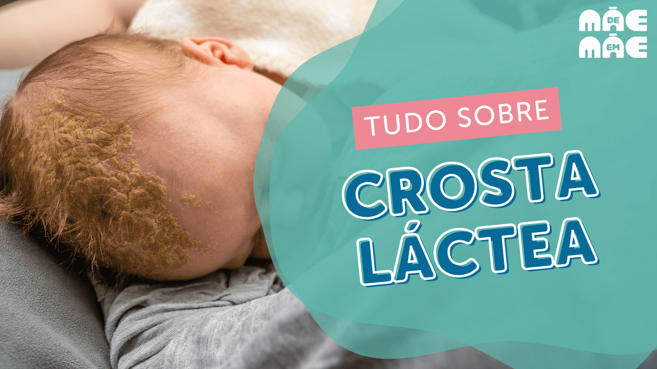 Leia mais sobre o artigo Crosta láctea em bebês: causas, sintomas e cuidados