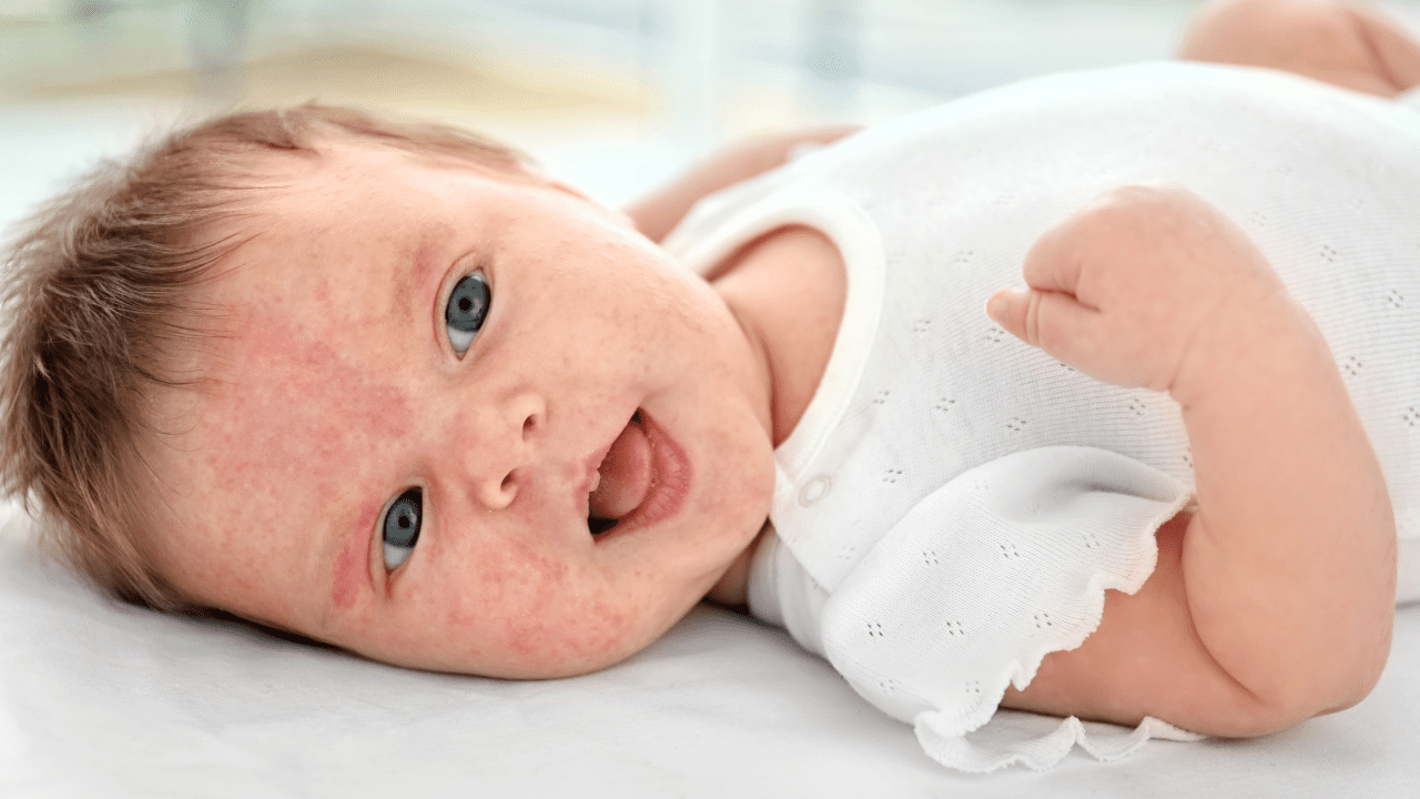 Alergias de pele em bebê