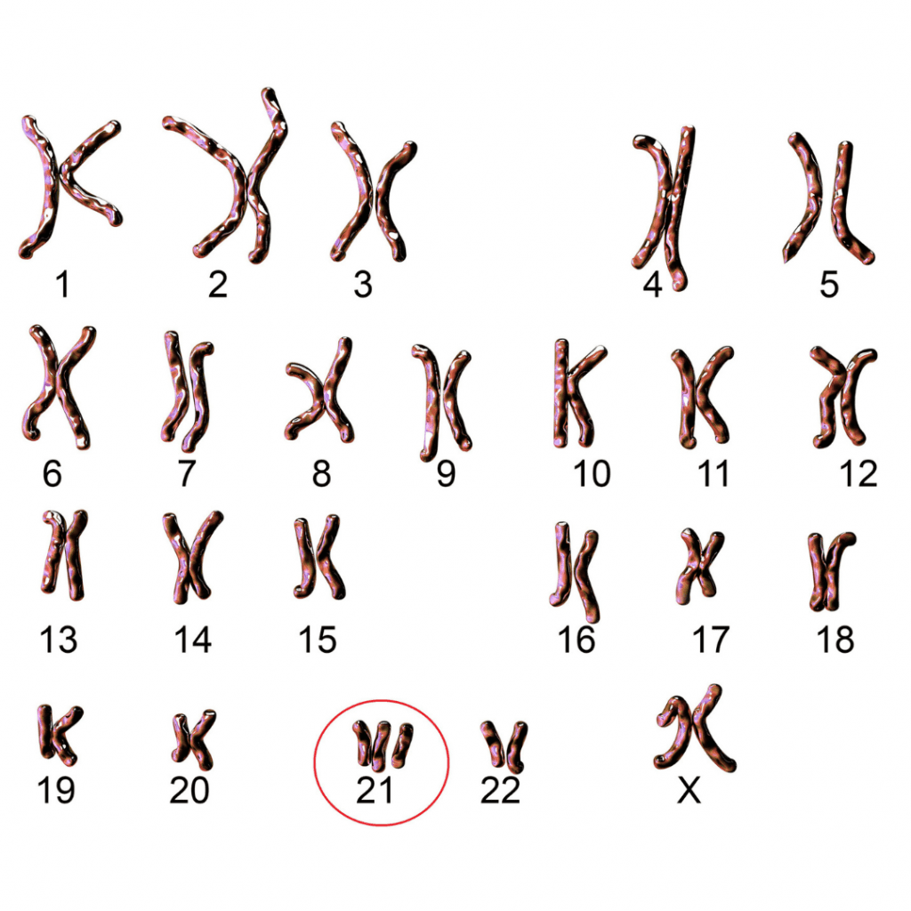 Trissomia do 21 - síndrome de down