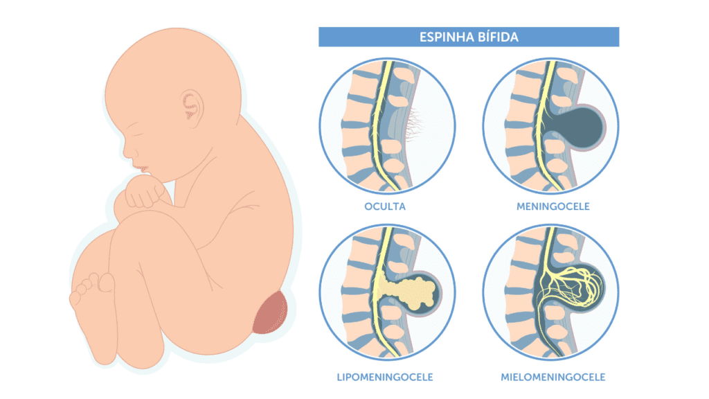 espinha bífida