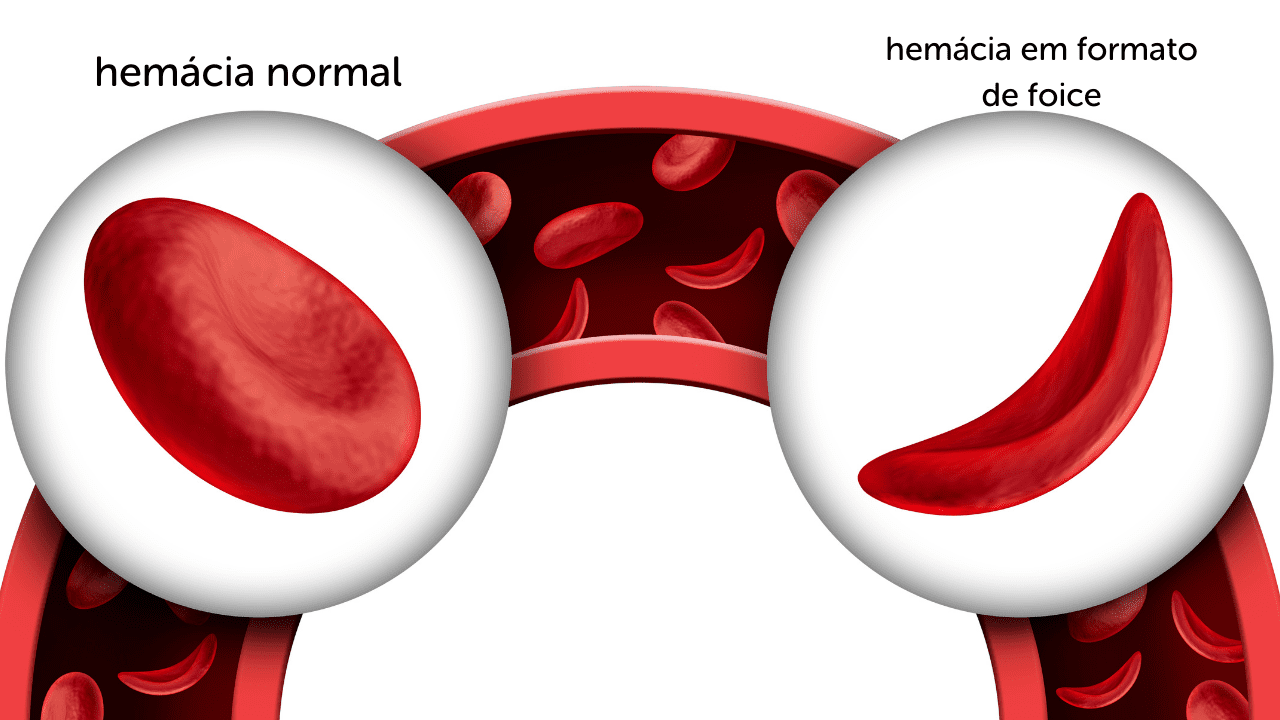 anemia em crianças