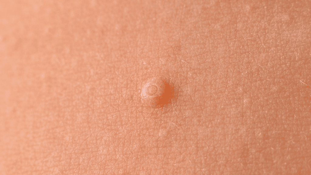 molusco contagioso