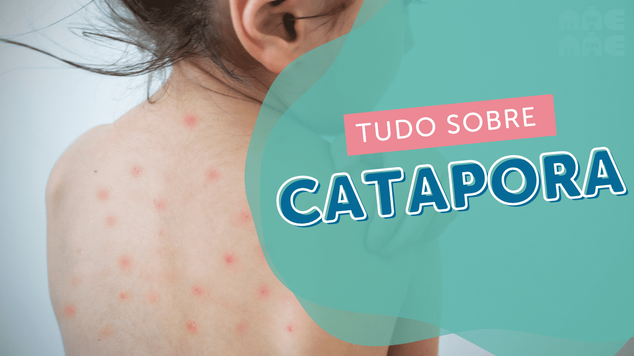 Você está visualizando atualmente Catapora: o que é, sintomas, tratamentos e causas