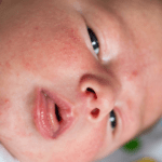 Brotoeja em bebês: por que ocorre e como tratar?