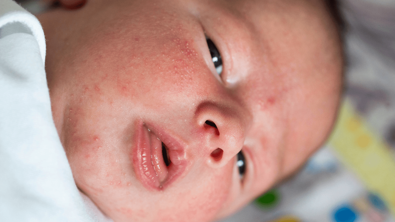 Você está visualizando atualmente Brotoeja em bebês: por que ocorre e como tratar?